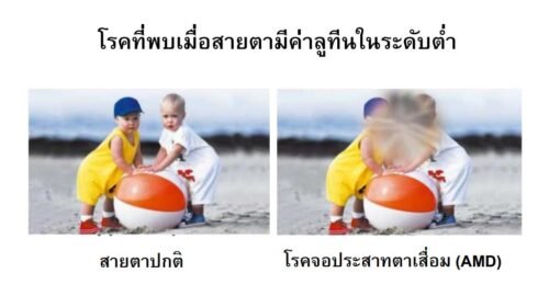 โรคจอประสาทตาเสื่อม